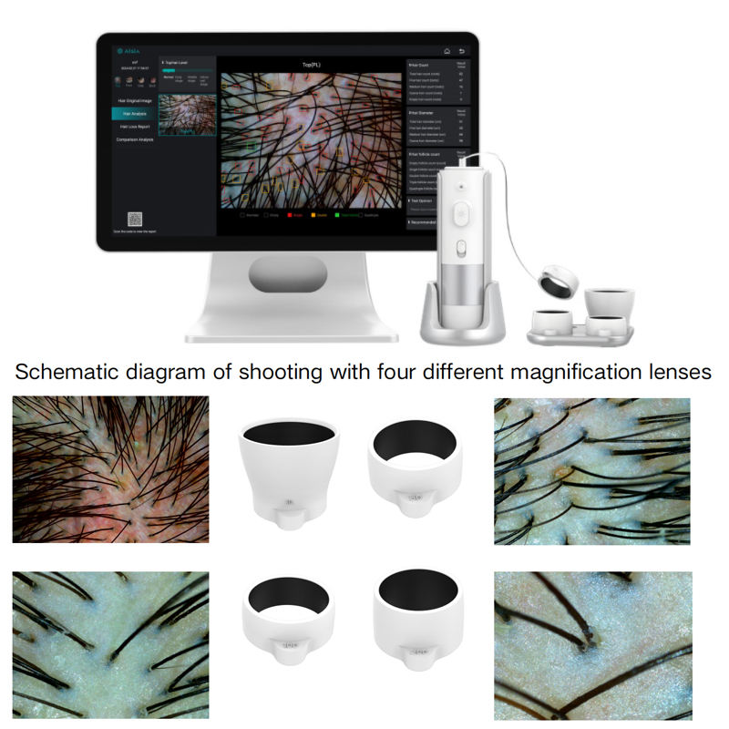 Professional Hair Mirror Scalp Analyzer Hair Follicle Analyzer with Pigmentation Blood Scab Diagnosis