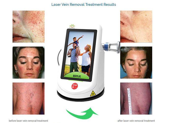 980nm/15w Spider Veins Removal Diode Therapy Laser for Vascular Lesions Telangiectasia Treatment
