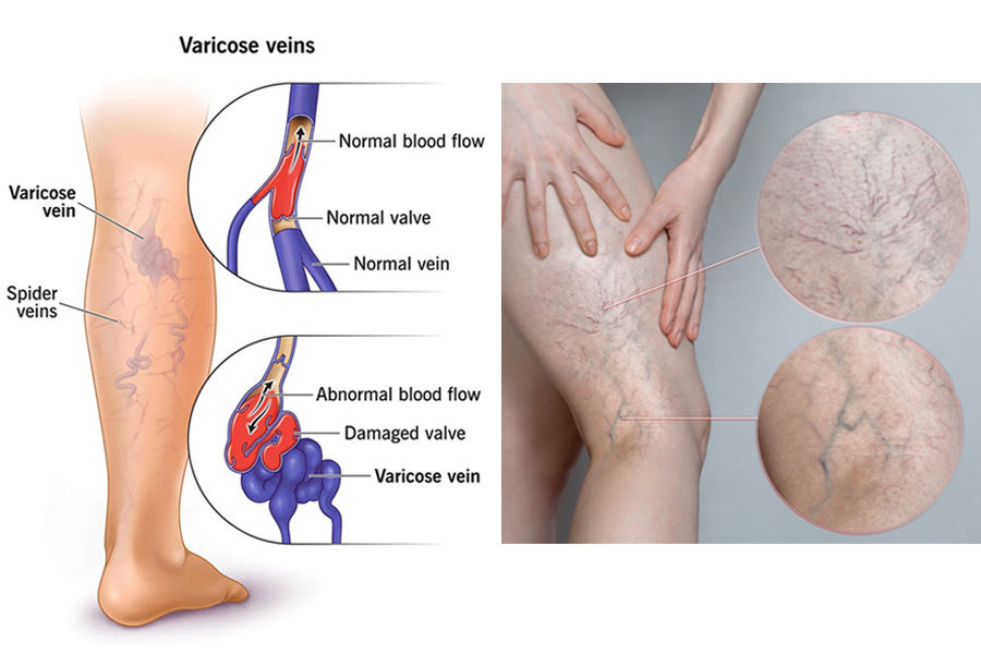 980nm/15w Spider Veins Removal Diode Therapy Laser for Vascular Lesions Telangiectasia Treatment